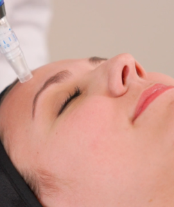 Woman not wasting time after finding out how often should you microneedle in Jacksonville